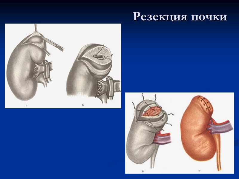 Резекция почки